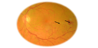 retina-damar-tikanikligi